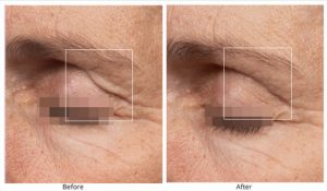 Which does better on anti-aging, Microcurrent or Radio Frequency?